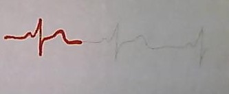 Principe d\'un lectrocardiogramme.