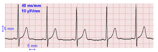 Le diagnostic mdical  ELECTROCARDIOGRAMME