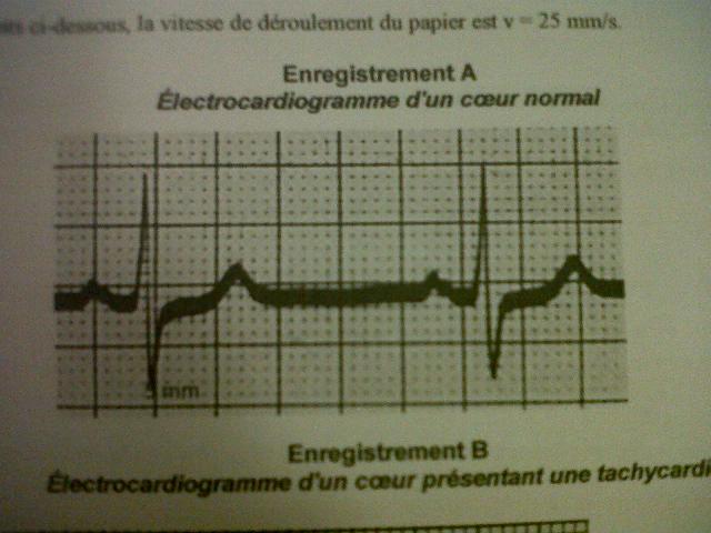 Les troubles du rythme cardiaque 