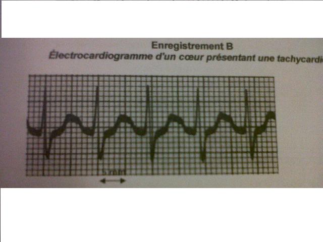 Les troubles du rythme cardiaque 