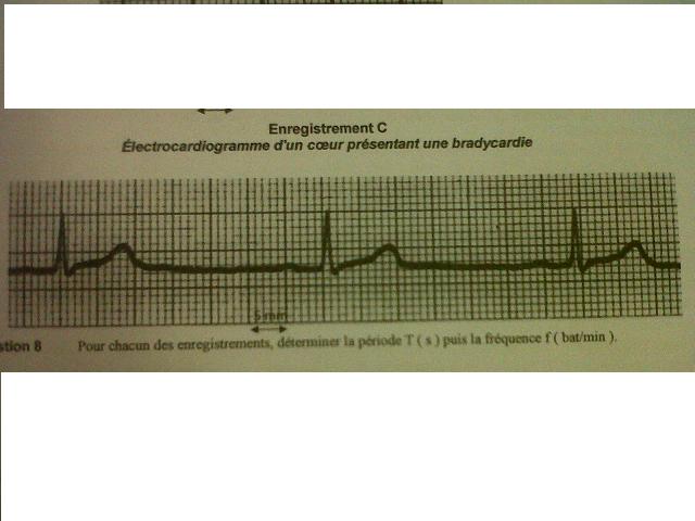 Les troubles du rythme cardiaque 