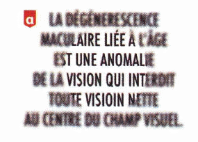 Les troubles de la DMLA et la cataracte