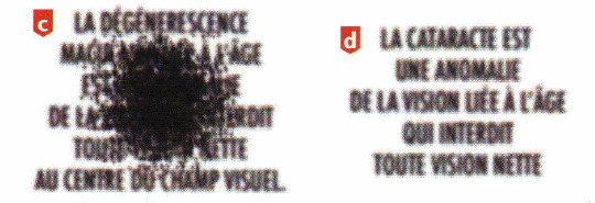 Les troubles de la DMLA et la cataracte