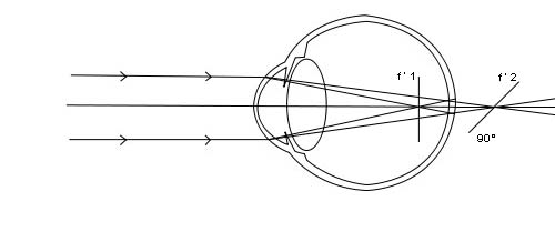 schma de l\'oeil astigmate