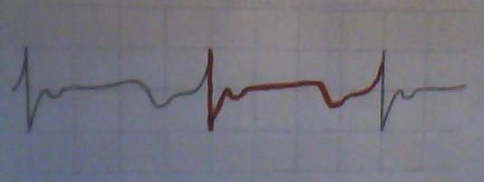 devoir maison sur l electrocardiogramme