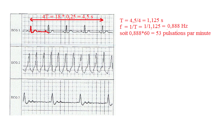 Dm de physique : Electrocardiogramme.