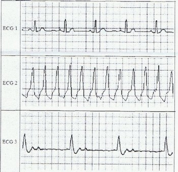 Dm de physique : Electrocardiogramme.