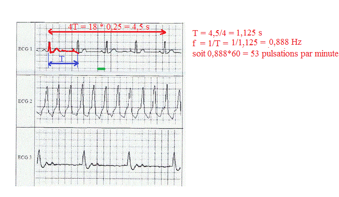 Dm de physique : Electrocardiogramme.
