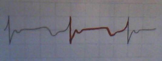 Voici l\'lectrocardiogramme 