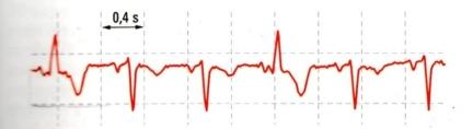 Anomalie dans un electrocardiogramme