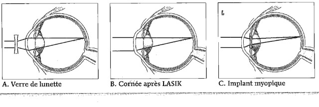 Comparer lentilles