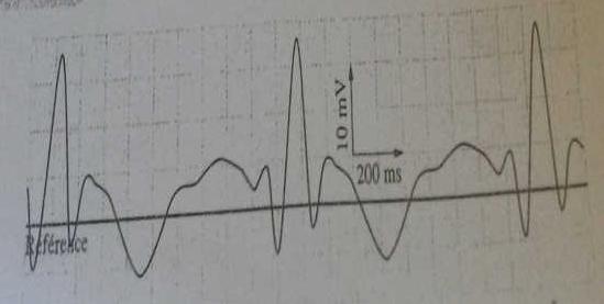Electrocardiogramme