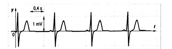 ECG, signal priodique, periode T, frquence