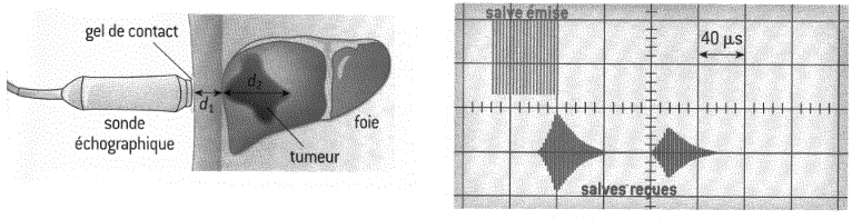 Echographie du foie