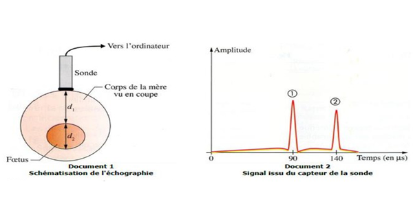 Echographie - Distance Foetus