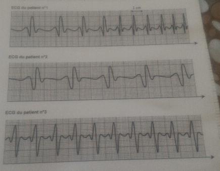 tude D\'lectrocardiogrammes