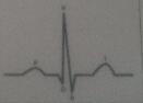 tude D\'lectrocardiogrammes