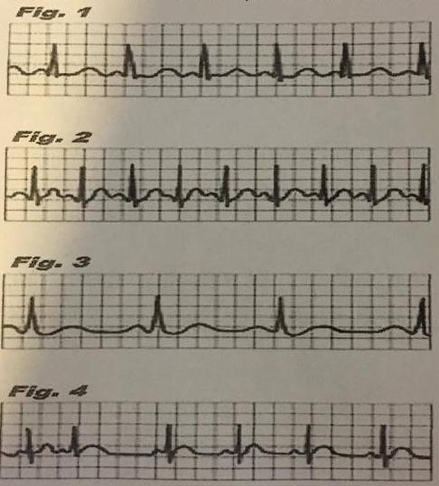 Exercice Physique lectrocardiogramme 